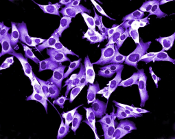 Melanoma_bis